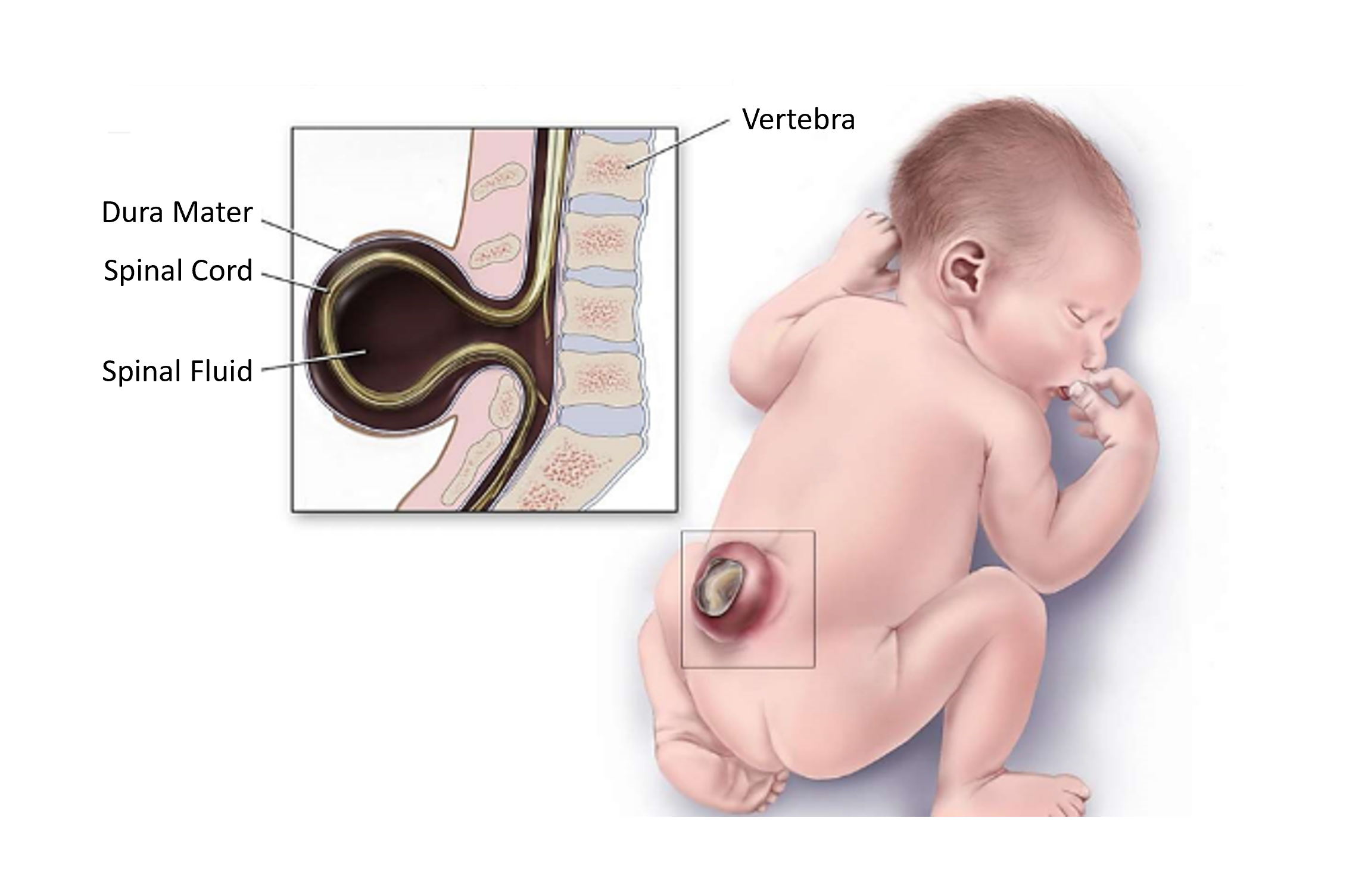 Baby with Spina Bifida